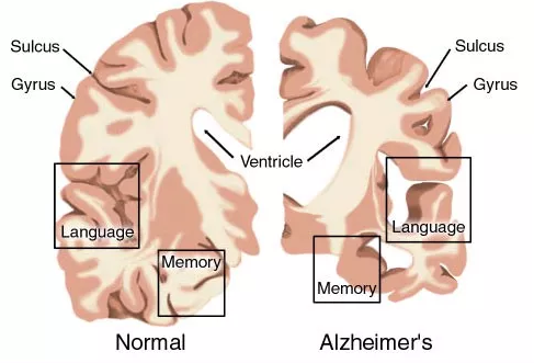 AD药物研发现状：辉瑞、礼来、百健、诺华、强生……
