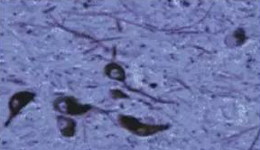 正常人：黑质神经元存在