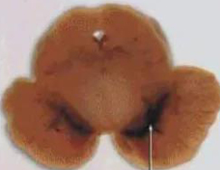 正常人：正常黑质