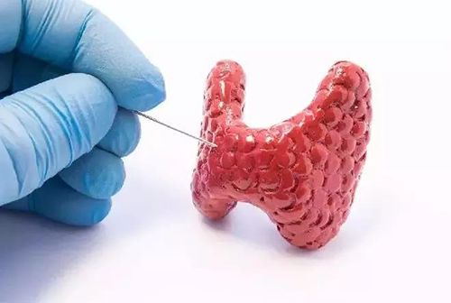 甲状腺疾。鬃聪俟δ芗跬撕图鬃聪俟δ芸航，自古以来就是反复被医学研究人员研究的疾病