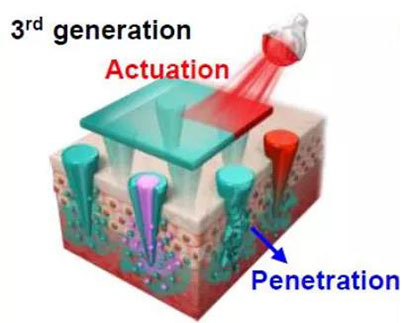 第三代：通过微针介导的皮肤层破坏和微针伴随的各种功能增强药物转运.jpg